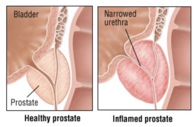 Gorilla Flow Versus Better Bladder Reviews